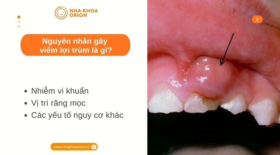 Nguy&ecirc;n nh&acirc;n g&acirc;y vi&ecirc;m lợi tr&ugrave;m l&agrave; g&igrave;?