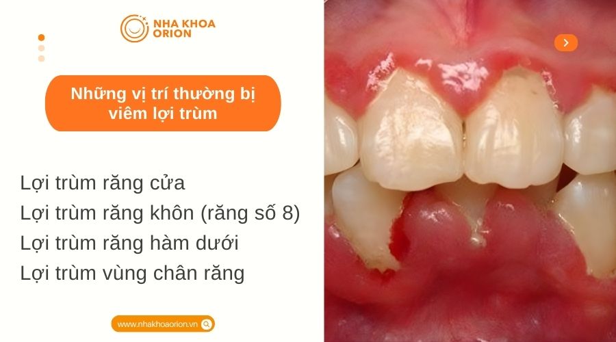 Những vị tr&iacute; thường bị vi&ecirc;m lợi tr&ugrave;m