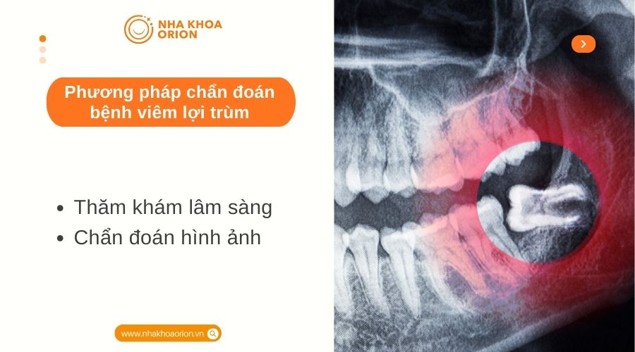 Phương ph&aacute;p chẩn đo&aacute;n bệnh vi&ecirc;m lợi tr&ugrave;m