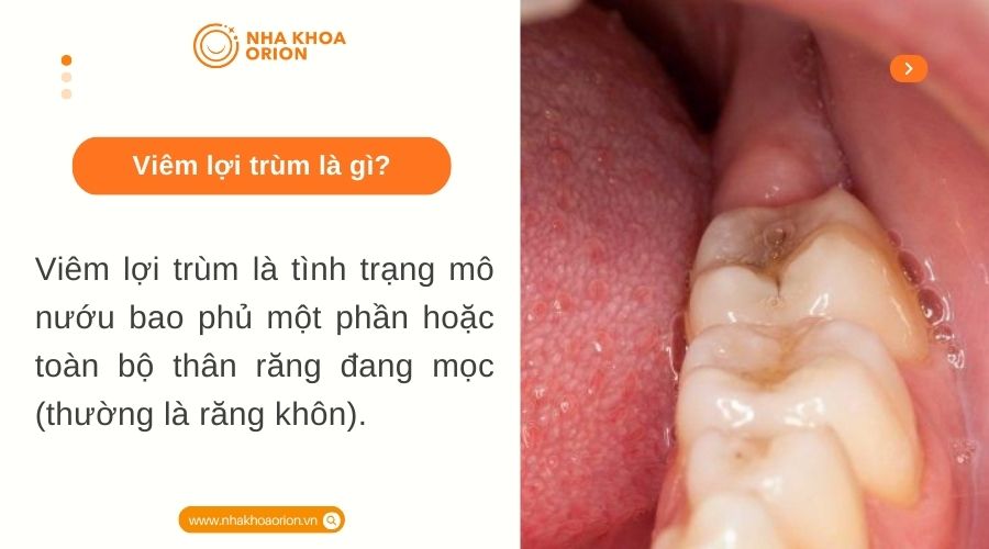 Vi&ecirc;m lợi tr&ugrave;m l&agrave; g&igrave;?
