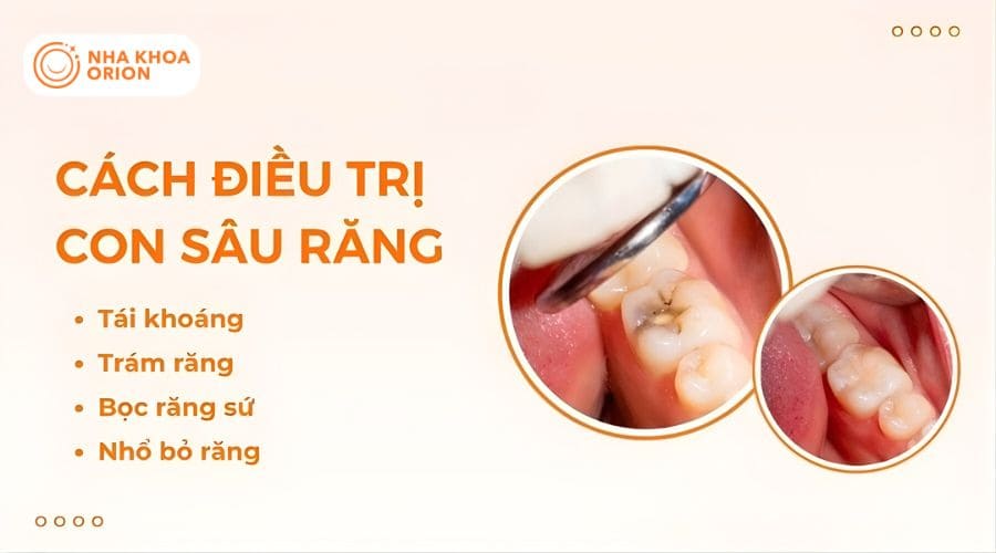 C&aacute;ch điều trị s&acirc;u răng chuẩn nha khoa