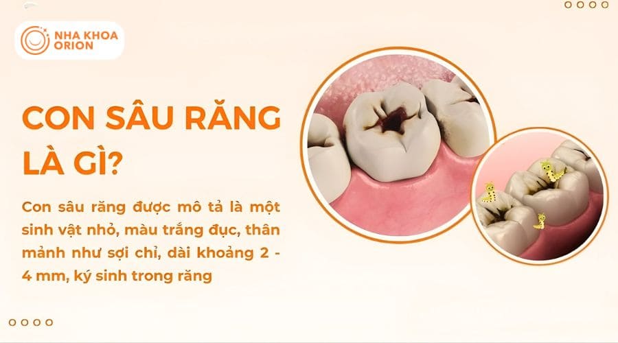 T&igrave;m hiểu sự thật về con s&acirc;u răng