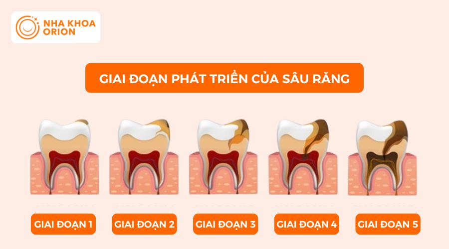 5 giai đoạn ph&aacute;t triển của s&acirc;u răng
