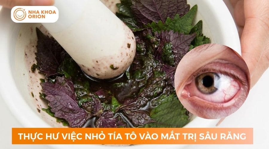 Nhỏ l&aacute; t&iacute;a t&ocirc; v&agrave;o mắt kh&ocirc;ng gi&uacute;p trị s&acirc;u răng