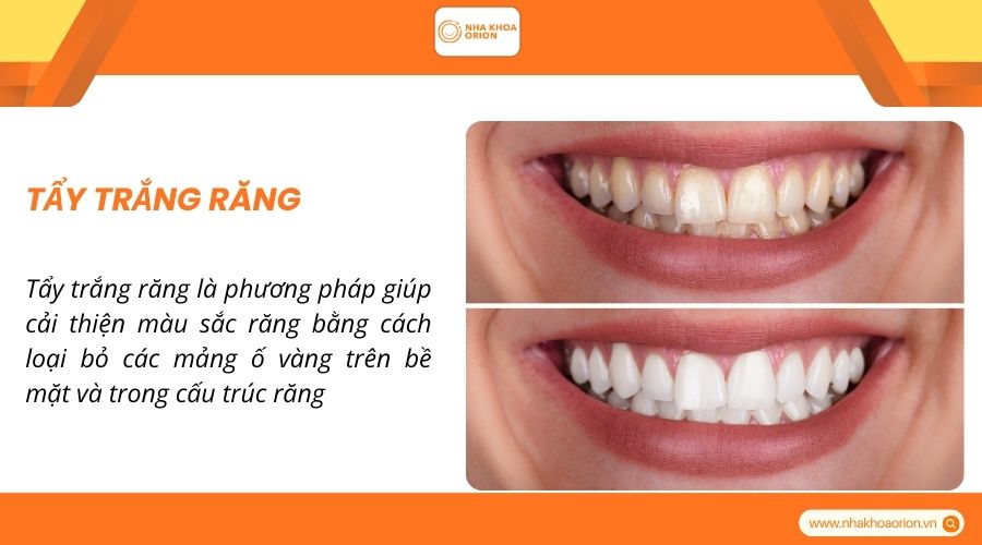 Tẩy trắng răng nụ cười tự tin tỏa s&aacute;ng