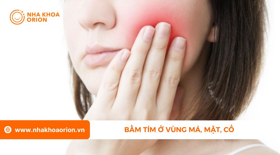 M&aacute; bị bầm t&iacute;m sau khi nhổ răng kh&ocirc;n