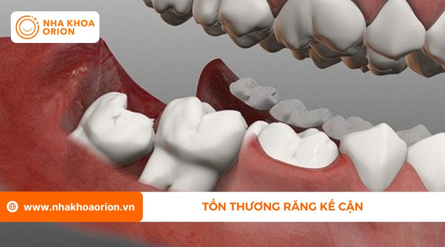 Tổn thương răng kề cận do răng kh&ocirc;n mọc lệch