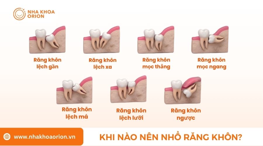 Những thời điểm n&ecirc;n nhổ răng kh&ocirc;n