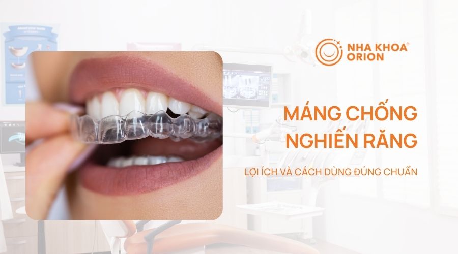 Lợi ích và cách dùng máng chống nghiến răng khi ngủ đúng chuẩn