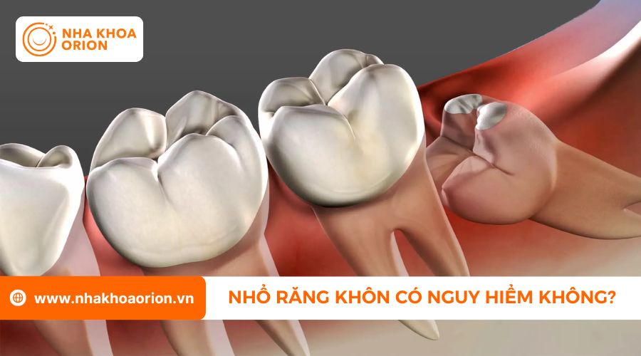 Giải đ&aacute;p nhổ răng kh&ocirc;n h&agrave;m dưới c&oacute; nguy hiểm kh&ocirc;ng
