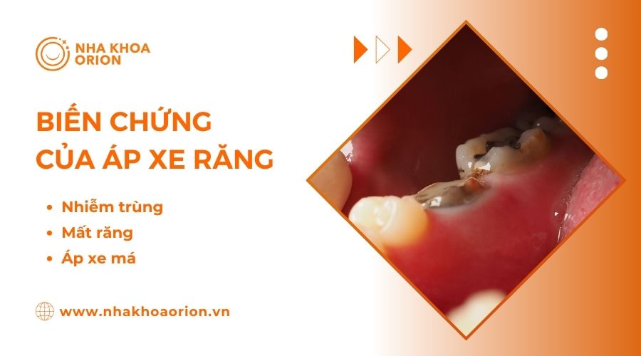 &Aacute;p xe răng cực kỳ nguy hiểm c&oacute; thể g&acirc;y xoang m&atilde;n t&iacute;nh