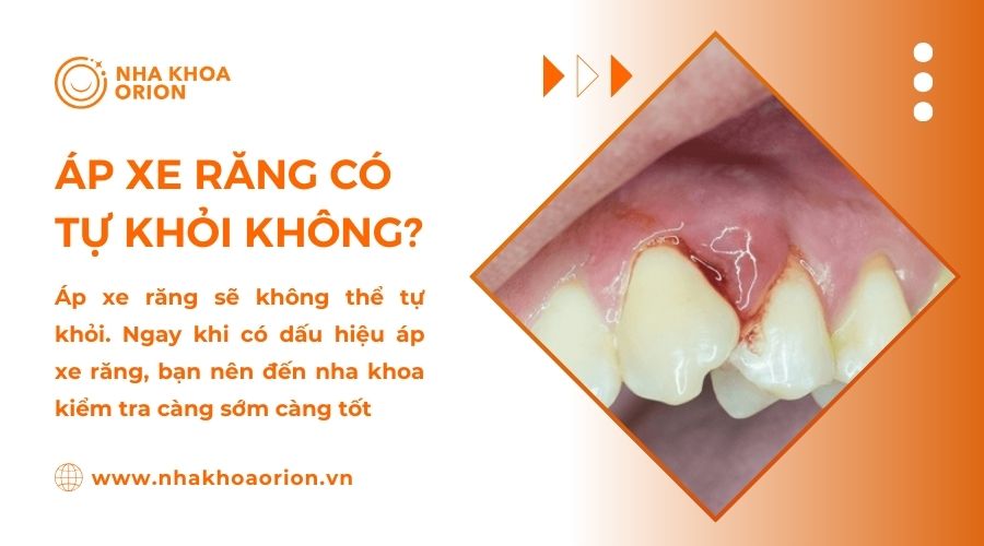 &Aacute;p xe răng kh&ocirc;ng thể tự khỏi m&agrave; cần sự can thiệp của b&aacute;c sĩ nha khoa