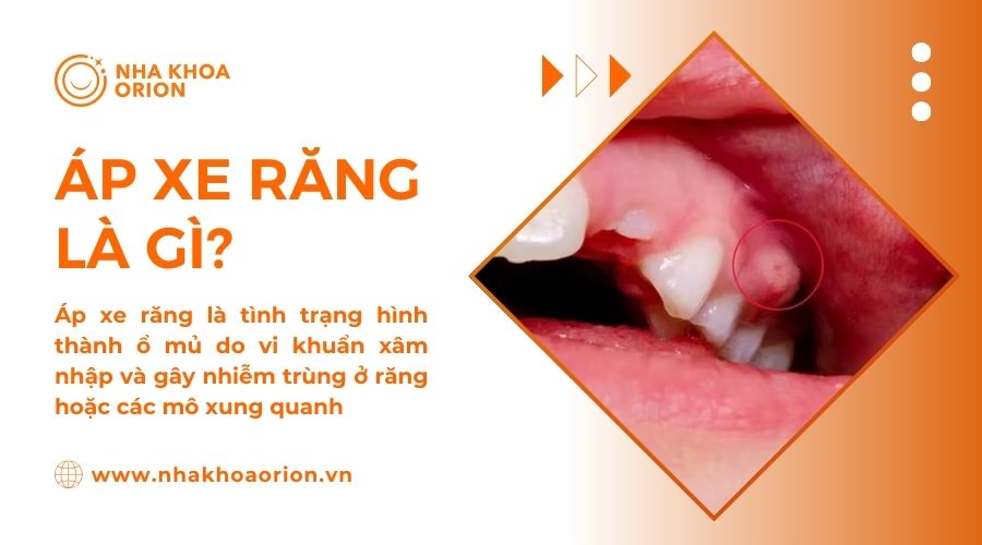&Aacute;p xe răng l&agrave; t&igrave;nh trạng nhiễm khuẩn ch&acirc;n răng hoặc c&aacute;c m&ocirc; xung quanh