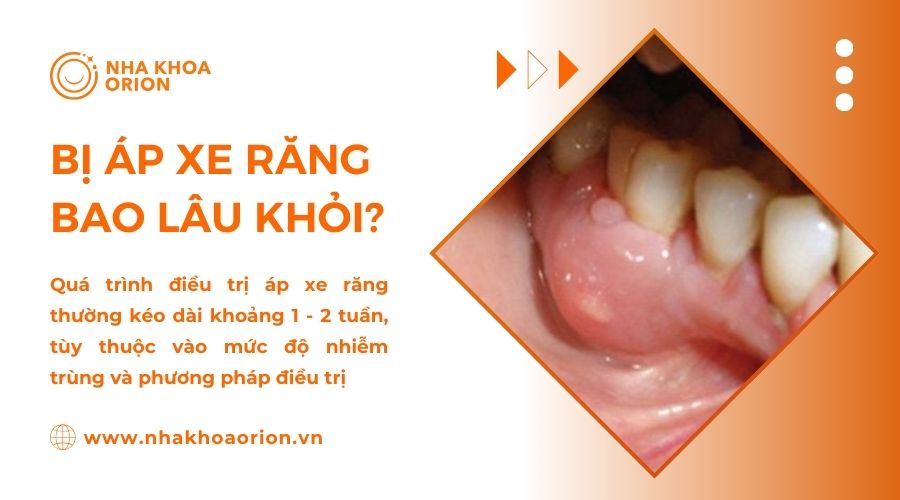 Sau khi điều trị &aacute;p xe răng bạn cần 1 - 2 tuần để hồi phục