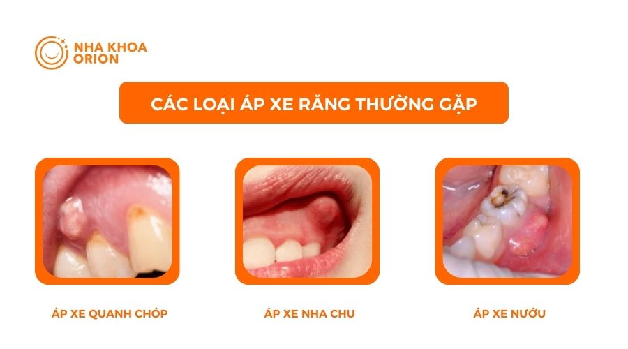 3 loại &aacute;p xe răng thường gặp