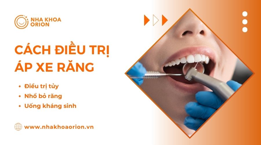 C&aacute;ch điều trị &aacute;p xe răng dứt điểm