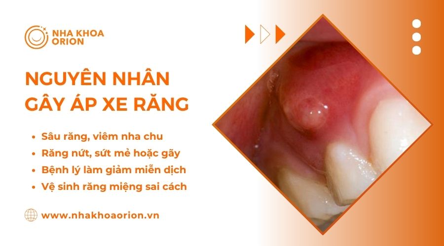 Nguy&ecirc;n nh&acirc;n g&acirc;y ra &aacute;p xe răng
