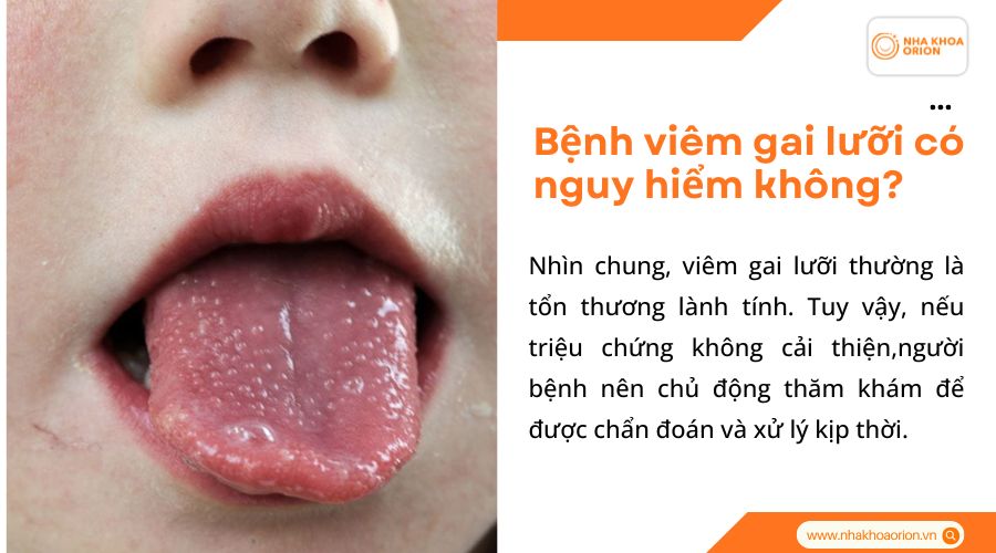 Bệnh vi&ecirc;m gai lưỡi c&oacute; nguy hiểm kh&ocirc;ng?