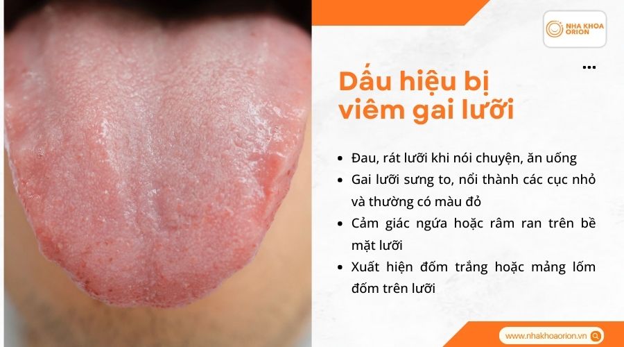 Dấu hiệu bị vi&ecirc;m gai lưỡi