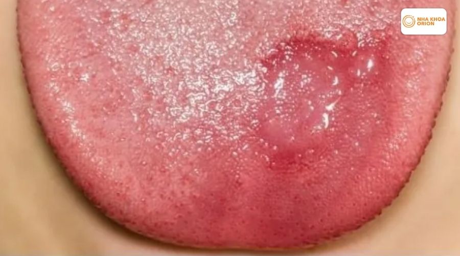 Vi&ecirc;m gai lưỡi ở giai đoạn đang ph&aacute;t triển