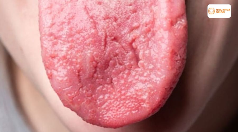 H&igrave;nh ảnh vi&ecirc;m gai lưỡi bị sưng vi&ecirc;m