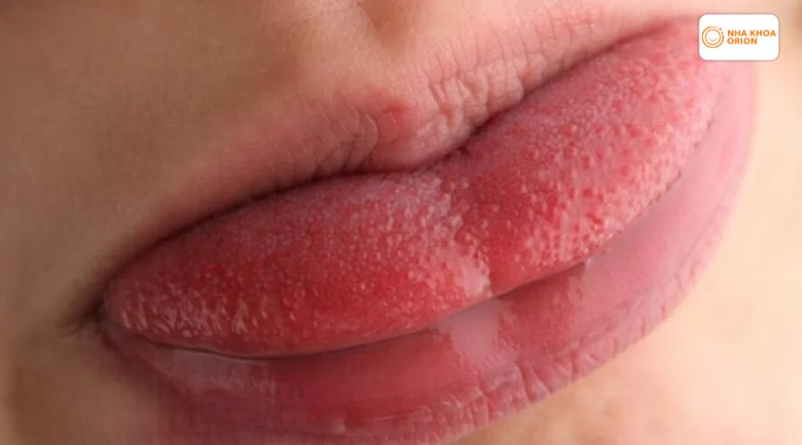 H&igrave;nh ảnh c&aacute;c gai lưỡi bị vi&ecirc;m