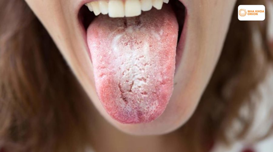 Gai lưỡi bị sưng nền xuất hiện mảng trắng 