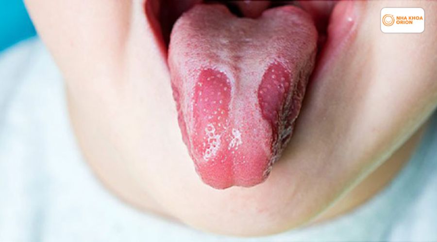 C&aacute;c nốt gai lưỡi bị vi&ecirc;m li ti xuất hiện r&otilde; hơn