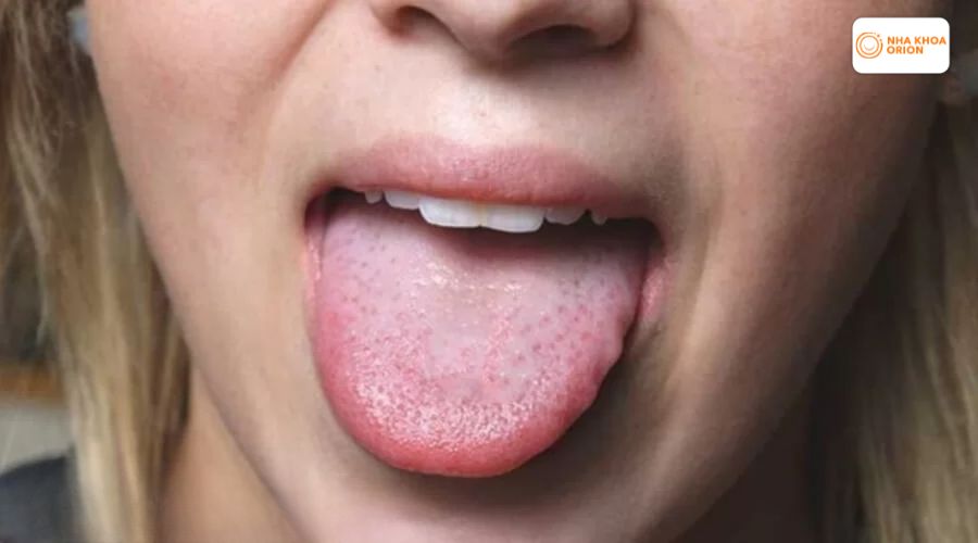 H&igrave;nh ảnh vi&ecirc;m gai lưỡi đang trong giai đoạn phục hồi