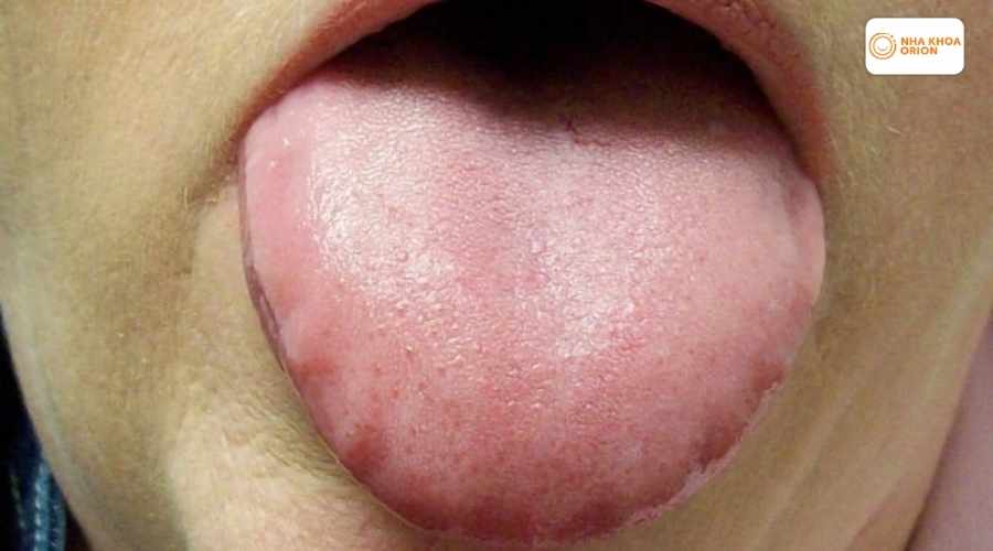 H&igrave;nh ảnh vi&ecirc;m gai lưỡi giai đoạn đầu