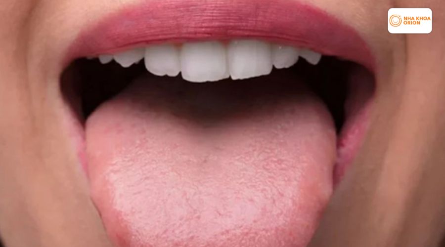 H&igrave;nh ảnh vi&ecirc;m gai lưỡi đ&atilde; ho&agrave;n to&agrave;n phục hồi