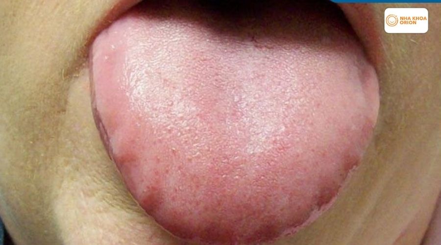 Ni&ecirc;m mạc lưỡi đang dần phục hồi kh&ocirc;ng c&ograve;n sưng vi&ecirc;m