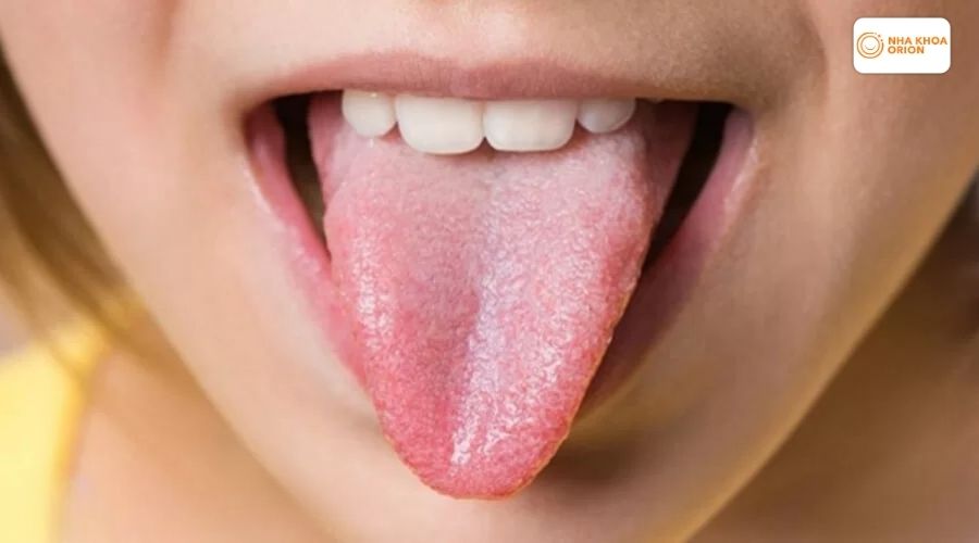 H&igrave;nh ảnh vi&ecirc;m gai lưỡi giai đoạn khởi ph&aacute;t