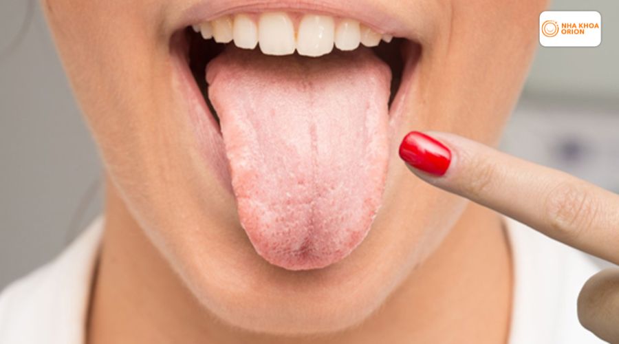 Bề mặt lưỡi vi&ecirc;m nhẹ, xuất hiện mảng trắng