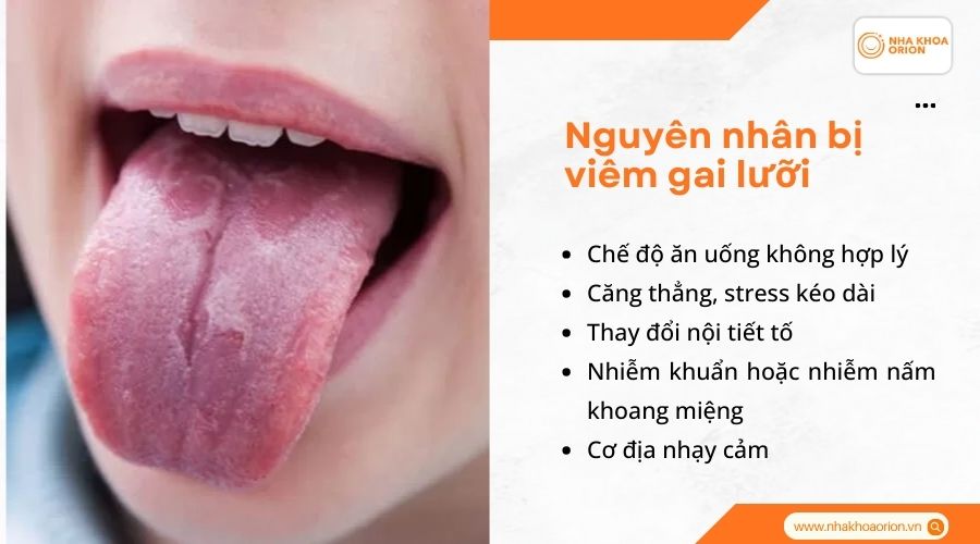 Nguy&ecirc;n nh&acirc;n bị vi&ecirc;m gai lưỡi