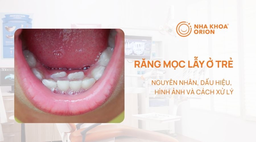 Răng mọc lẫy ở trẻ: Nguyên nhân, dấu hiệu, hình ảnh và cách xử lý