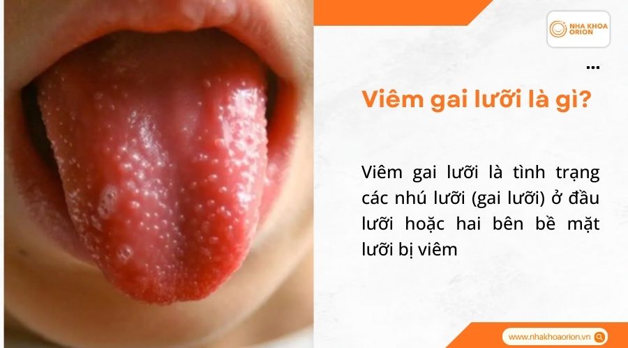 Vi&ecirc;m gai lưỡi l&agrave; g&igrave;?