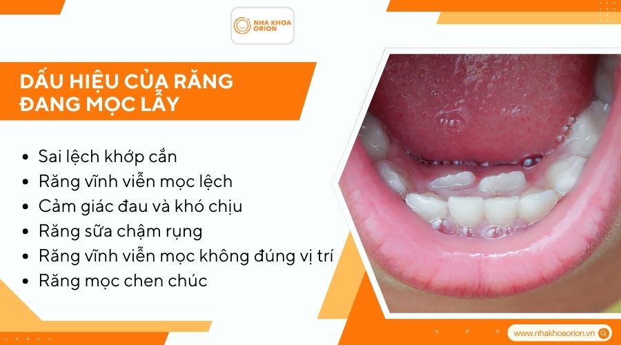 Dấu hiệu của răng mọc lẫy ở trẻ