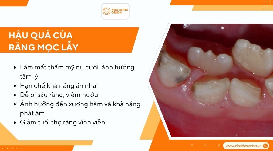 Hậu quả của răng mọc lẫy