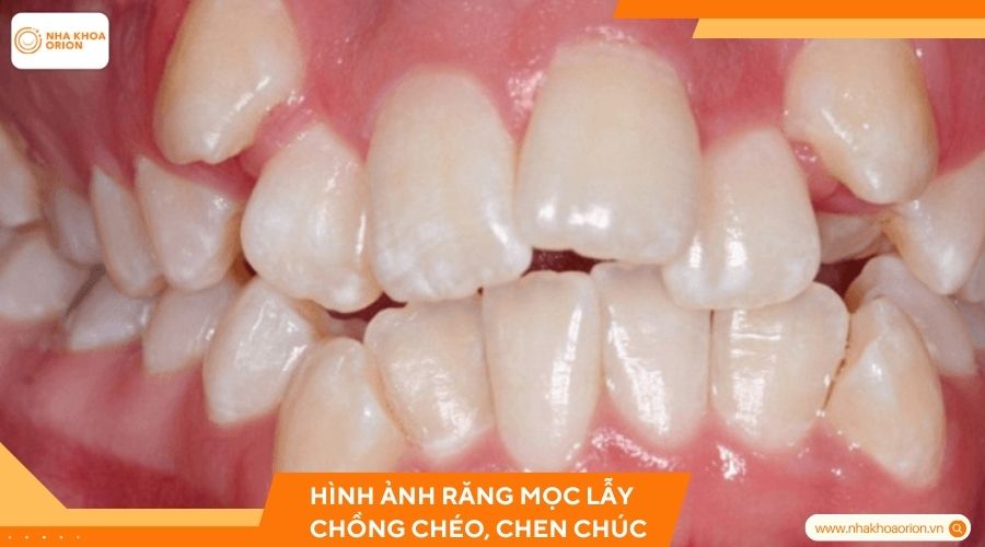 Hình ảnh răng mọc lẫy chồng chéo, chen chúc