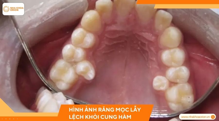 Hình ảnh răng mọc lẫy lệch khỏi cung hàm