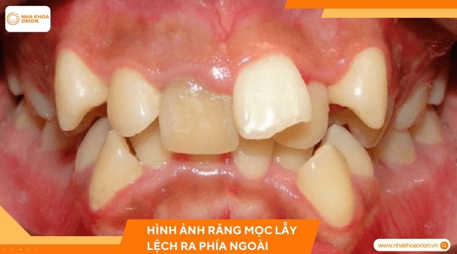 Hình ảnh răng mọc lẫy lệch ra phía ngoài