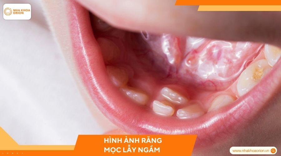 Hình ảnh răng mọc lẫy ngầm