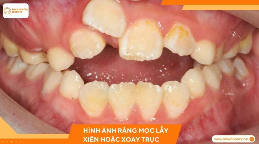 Hình ảnh răng mọc lẫy xiên hoặc xoay trục