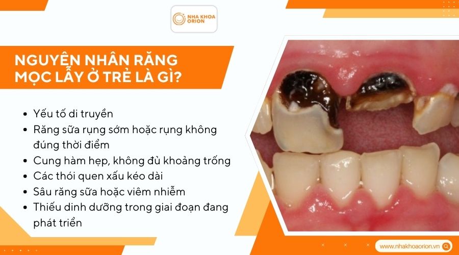 Nguyên nhân răng mọc lẫy ở trẻ là gì?
