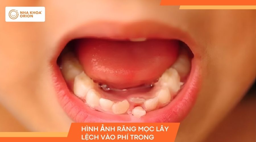 Hình ảnh răng mọc lẫy vào phía trong