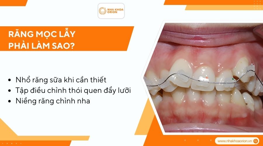 Răng mọc lẫy phải làm sao?