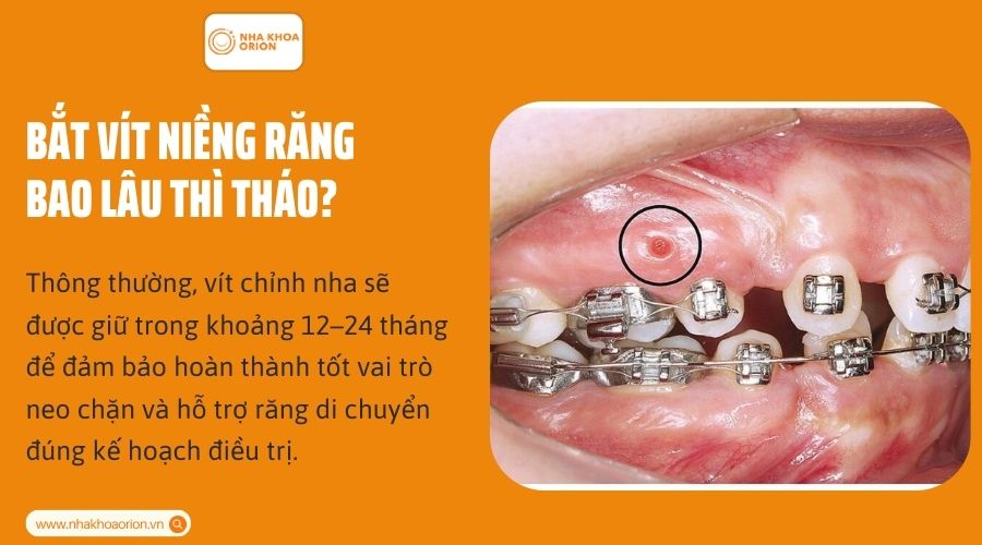 Bắt v&iacute;t niềng răng bao l&acirc;u th&igrave; th&aacute;o?