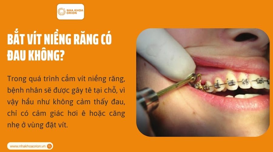 Bắt v&iacute;t niềng răng c&oacute; đau kh&ocirc;ng?