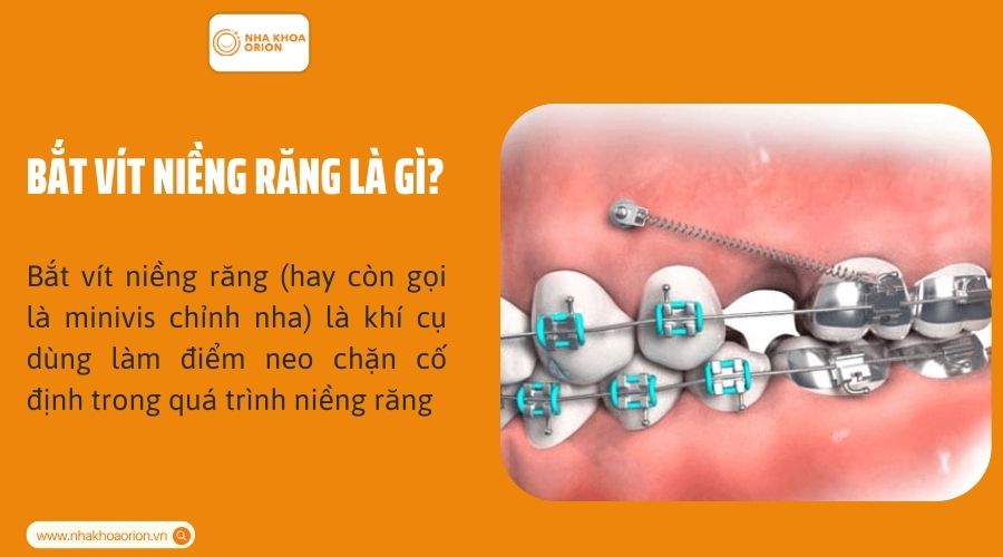 Bắt v&iacute;t niềng răng l&agrave; g&igrave;?